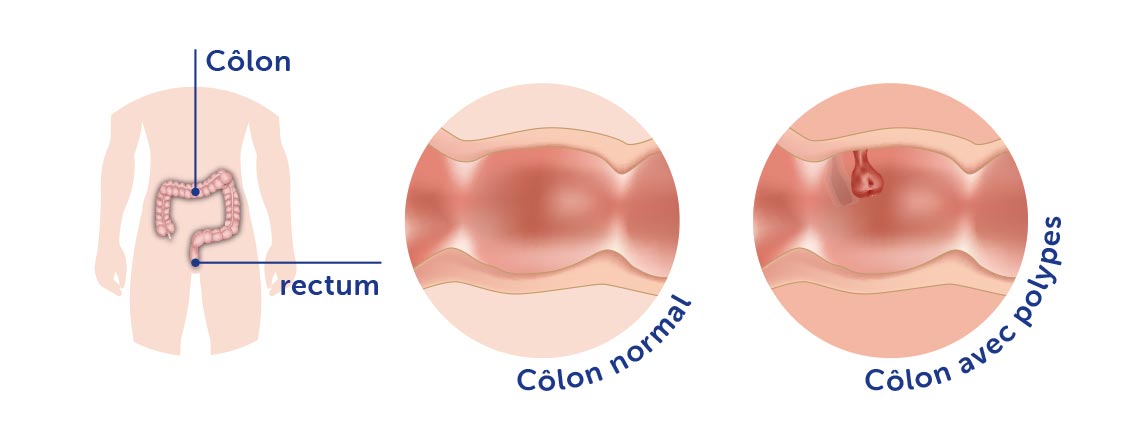 Cancer colorectal